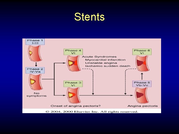 Stents 