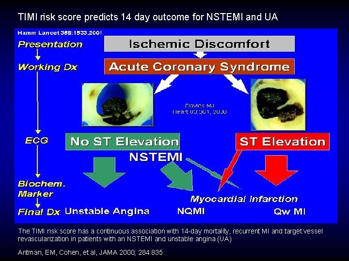 TIMI risk score predicts 14 day outcome for NSTEMI and UA The TIMI risk