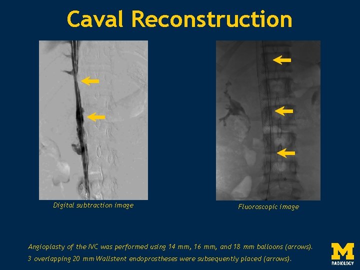 Caval Reconstruction Digital subtraction image Fluoroscopic image Angioplasty of the IVC was performed using