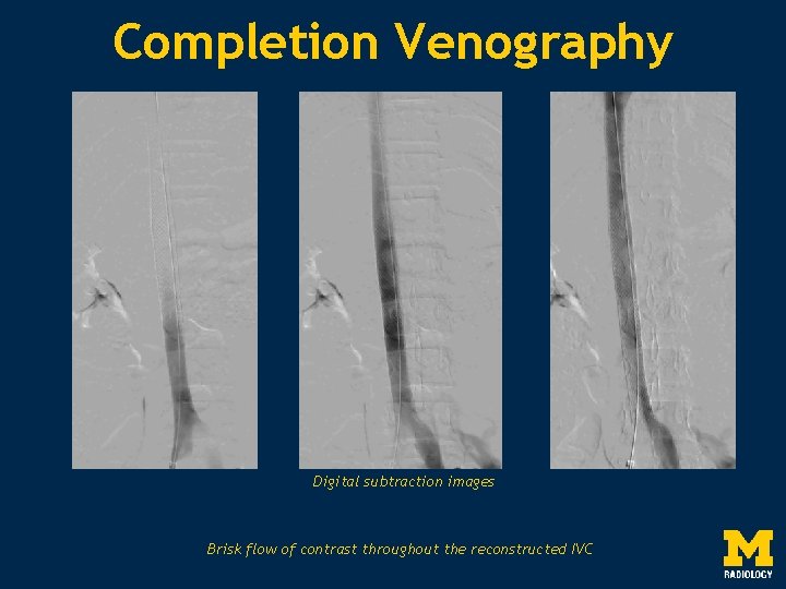 Completion Venography Digital subtraction images Brisk flow of contrast throughout the reconstructed IVC 