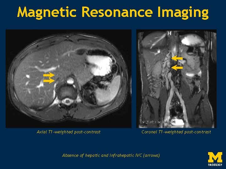 Magnetic Resonance Imaging Axial T 1 -weighted post-contrast Coronal T 1 -weighted post-contrast Absence