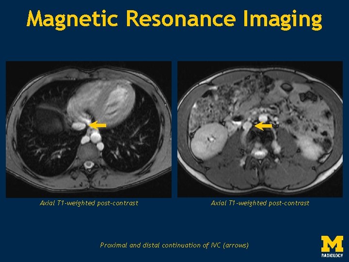 Magnetic Resonance Imaging Axial T 1 -weighted post-contrast Proximal and distal continuation of IVC