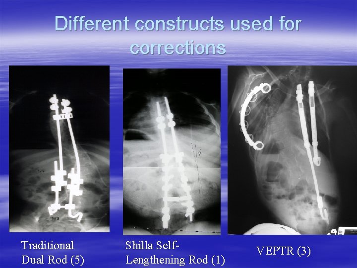 Shillla Rods Growing Rods in Myelomeningocele for Scoliosis Treatment Long
