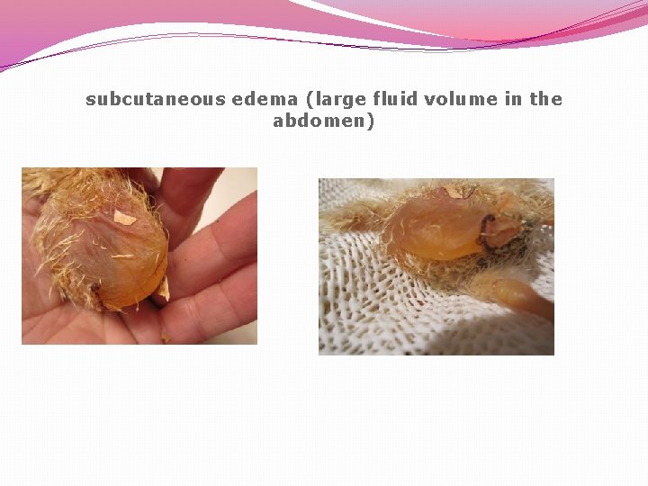 subcutaneous edema (large fluid volume in the abdomen) 