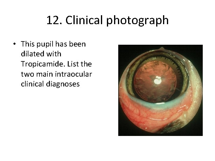 12. Clinical photograph • This pupil has been dilated with Tropicamide. List the two