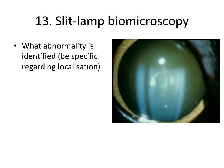 13. Slit-lamp biomicroscopy • What abnormality is identified (be specific regarding localisation) 