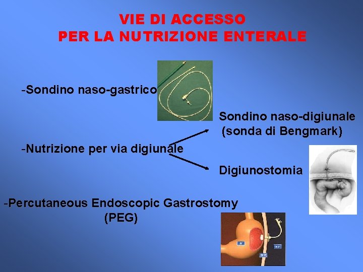 VIE DI ACCESSO PER LA NUTRIZIONE ENTERALE -Sondino naso-gastrico Sondino naso-digiunale (sonda di Bengmark)