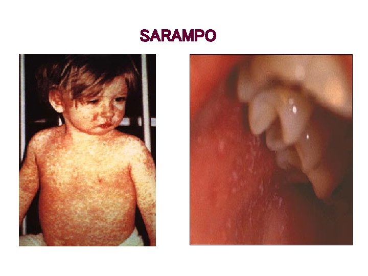 SARAMPO 
