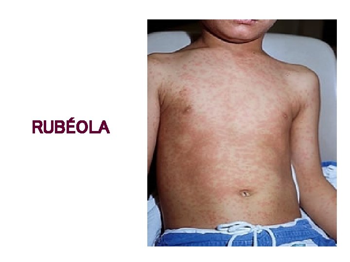 RUBÉOLA 