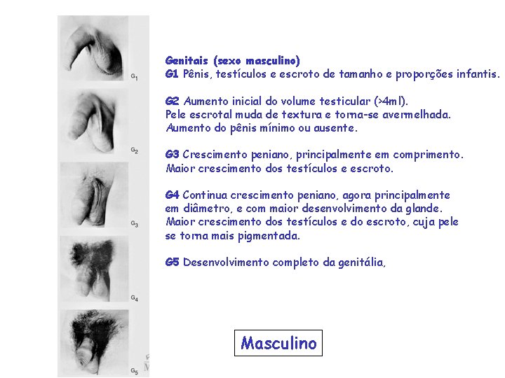 Genitais (sexo masculino) G 1 Pênis, testículos e escroto de tamanho e proporções infantis.