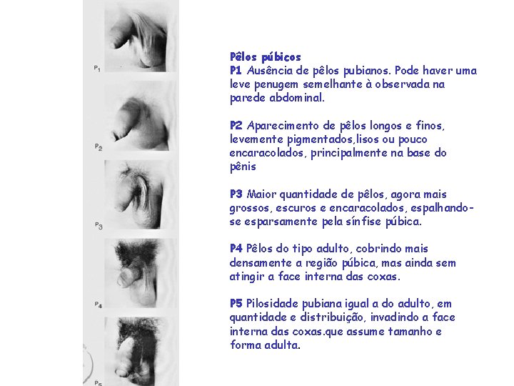 Pêlos púbicos P 1 Ausência de pêlos pubianos. Pode haver uma leve penugem semelhante