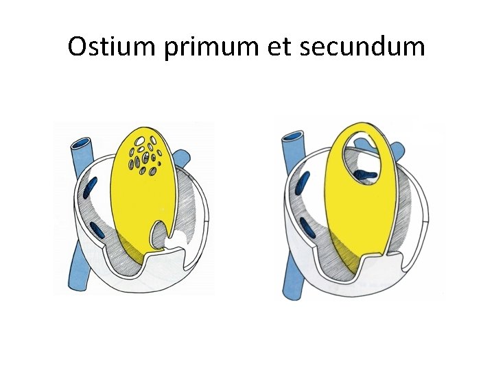 Ostium primum et secundum 