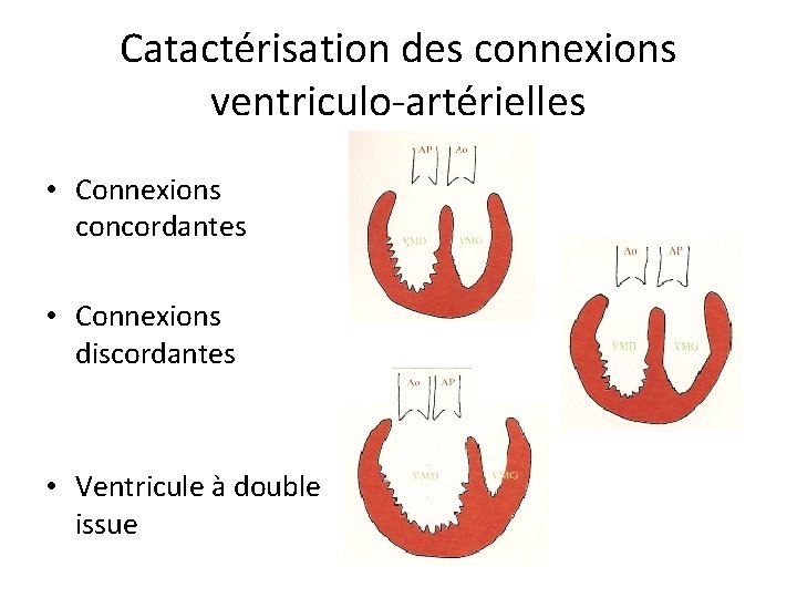 Catactérisation des connexions ventriculo-artérielles • Connexions concordantes • Connexions discordantes • Ventricule à double