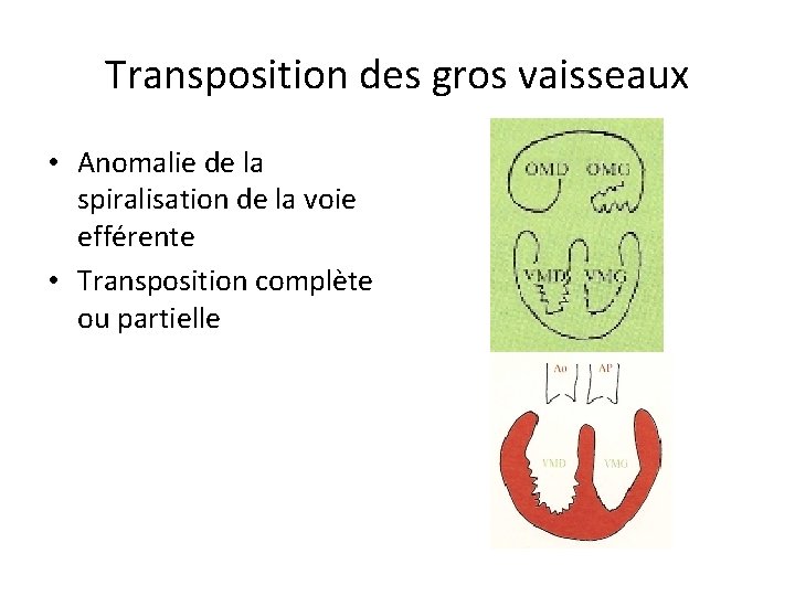 Transposition des gros vaisseaux • Anomalie de la spiralisation de la voie efférente •