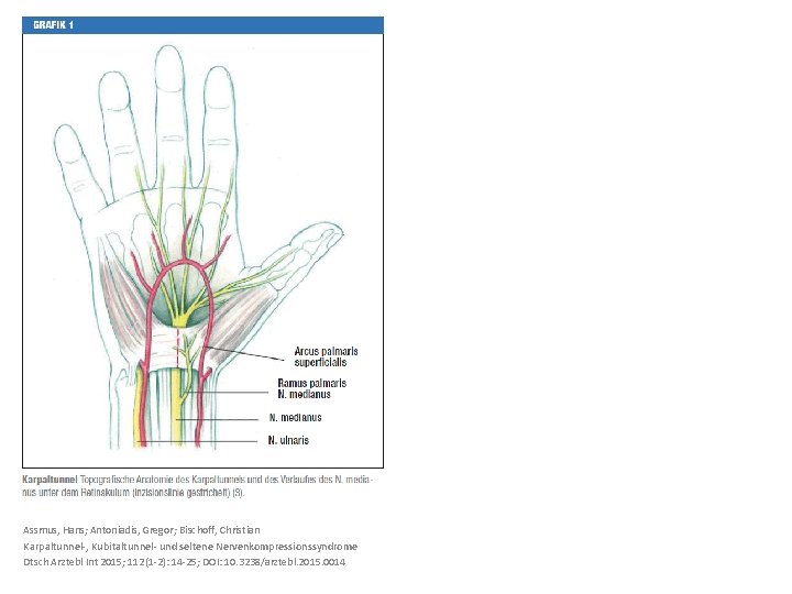 Assmus, Hans; Antoniadis, Gregor; Bischoff, Christian Karpaltunnel-, Kubitaltunnel- und seltene Nervenkompressionssyndrome Dtsch Arztebl Int