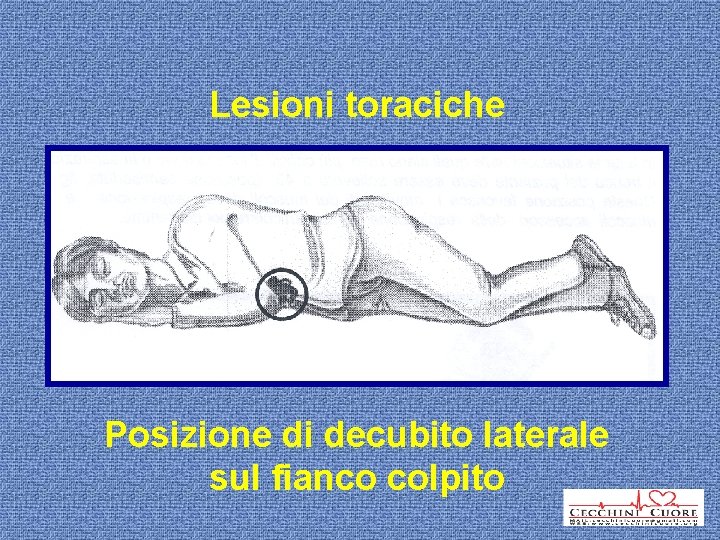 Lesioni toraciche Posizione di decubito laterale sul fianco colpito 