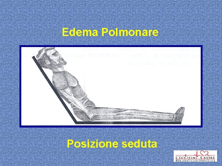 Edema Polmonare Posizione seduta 