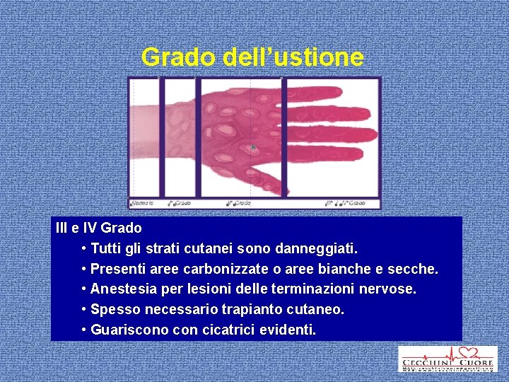 Grado dell’ustione III Grado III e IV Grado • Tutti Ustione L’ustione gli strati