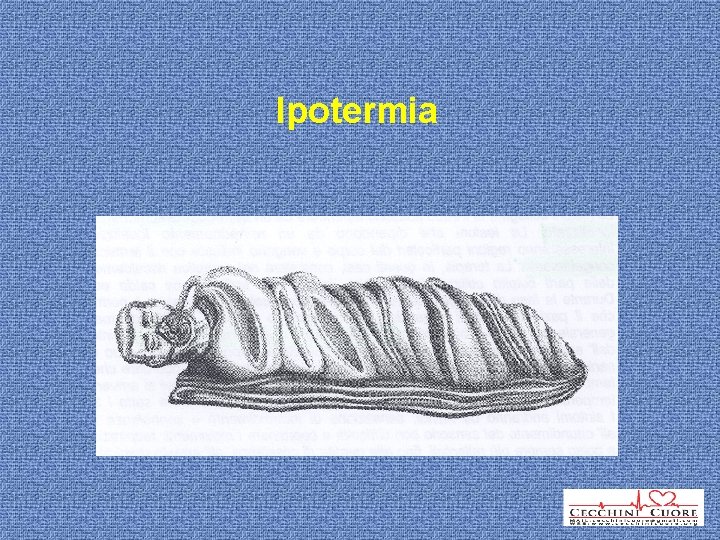 Ipotermia 