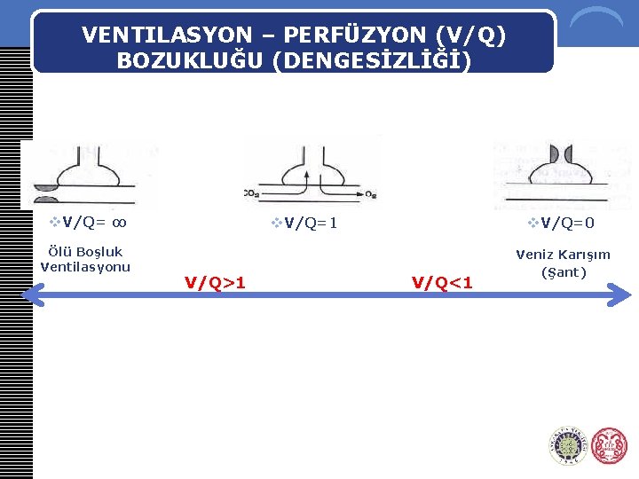 VENTILASYON – PERFÜZYON (V/Q) BOZUKLUĞU (DENGESİZLİĞİ) v. V/Q= ∞ Ölü Boşluk Ventilasyonu v. V/Q=1