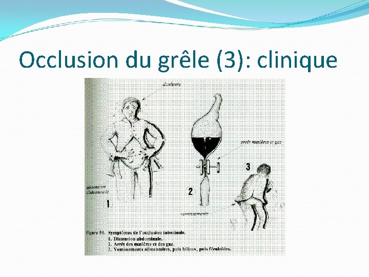 Occlusion du grêle (3): clinique 