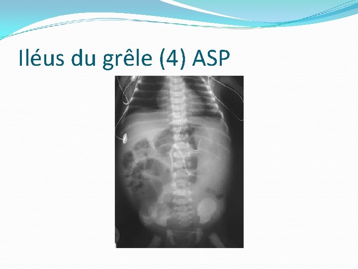 Iléus du grêle (4) ASP 