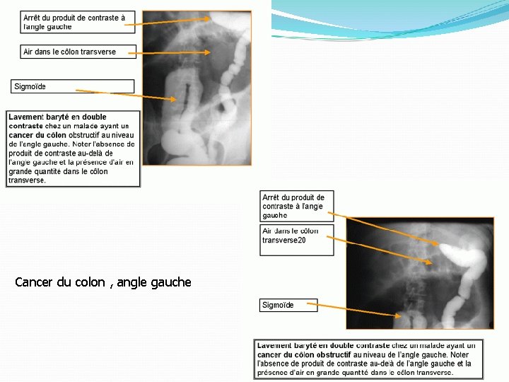 Cancer du colon , angle gauche 