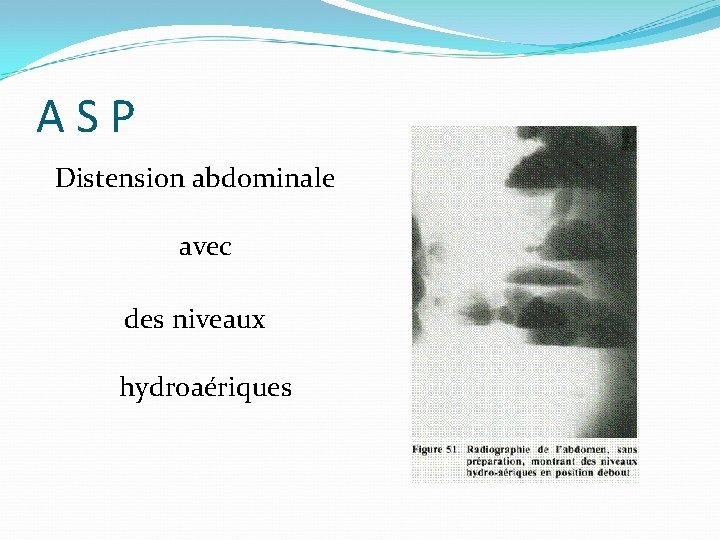 ASP Distension abdominale avec des niveaux hydroaériques 