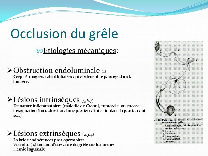 Occlusion du grêle Etiologies mécaniques: Ø Obstruction endoluminale (1) Corps étrangers, calcul biliaires qui