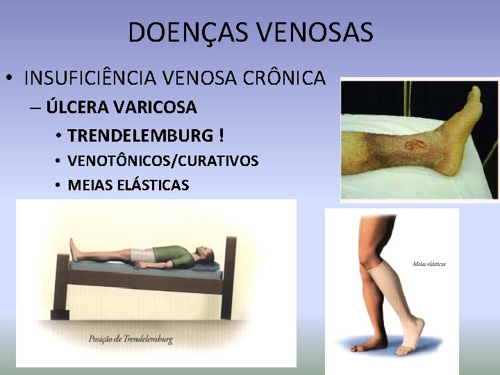 DOENÇAS VENOSAS • INSUFICIÊNCIA VENOSA CRÔNICA – ÚLCERA VARICOSA • TRENDELEMBURG ! • VENOTÔNICOS/CURATIVOS