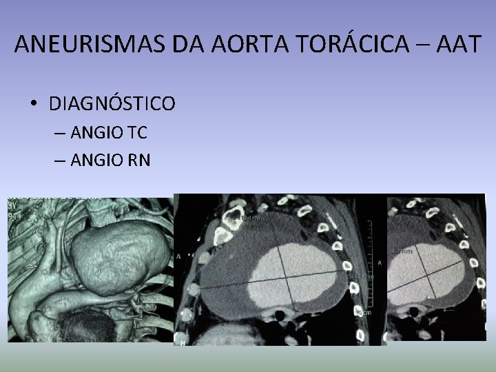 ANEURISMAS DA AORTA TORÁCICA – AAT • DIAGNÓSTICO – ANGIO TC – ANGIO RN
