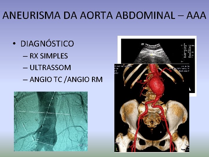 ANEURISMA DA AORTA ABDOMINAL – AAA • DIAGNÓSTICO – RX SIMPLES – ULTRASSOM –