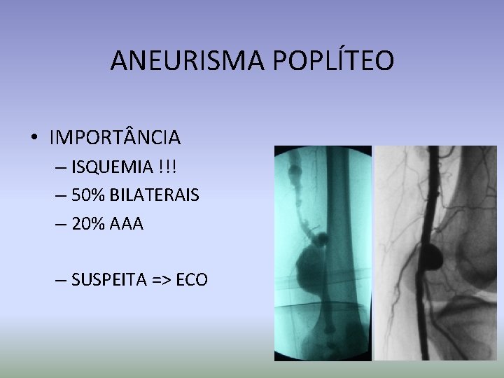 ANEURISMA POPLÍTEO • IMPORT NCIA – ISQUEMIA !!! – 50% BILATERAIS – 20% AAA