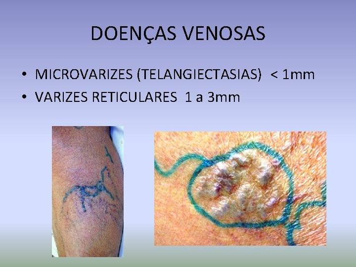 DOENÇAS VENOSAS • MICROVARIZES (TELANGIECTASIAS) < 1 mm • VARIZES RETICULARES 1 a 3