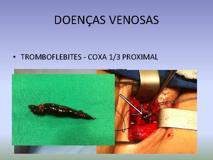 DOENÇAS VENOSAS • TROMBOFLEBITES - COXA 1/3 PROXIMAL 
