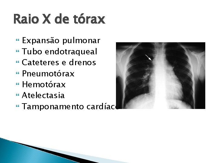 Raio X de tórax Expansão pulmonar Tubo endotraqueal Cateteres e drenos Pneumotórax Hemotórax Atelectasia Raio X de tórax Expansão pulmonar Tubo endotraqueal Cateteres e drenos Pneumotórax Hemotórax Atelectasia