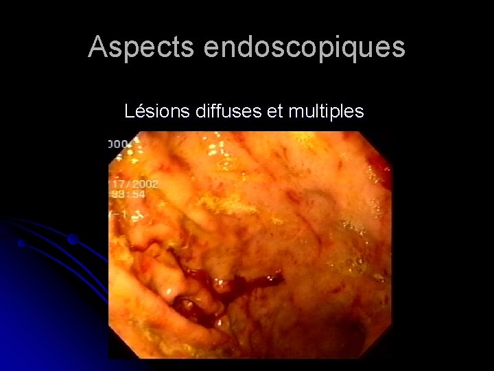 Aspects endoscopiques Lésions diffuses et multiples 