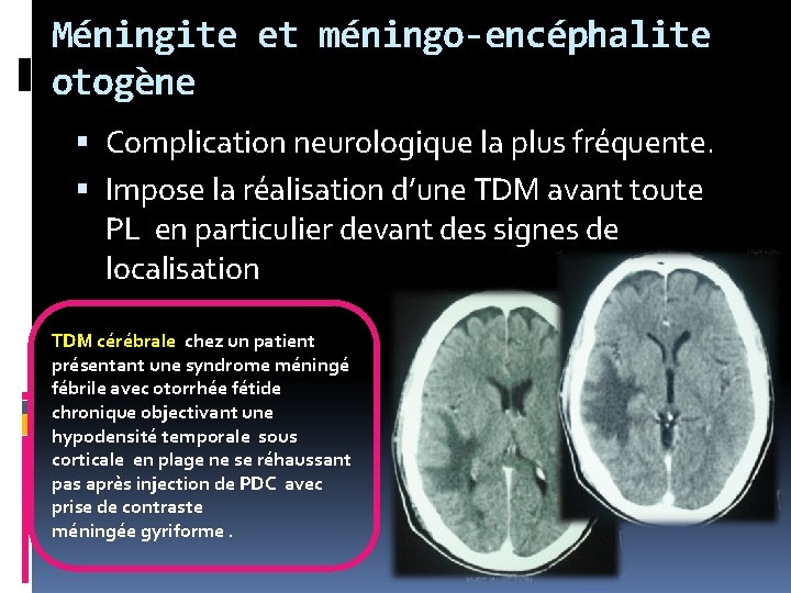 Méningite et méningo-encéphalite otogène Complication neurologique la plus fréquente. Impose la réalisation d’une TDM