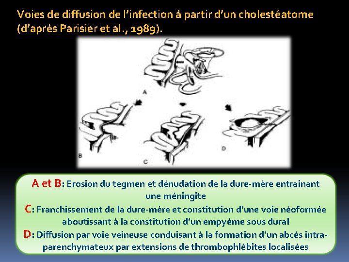 Voies de diffusion de l’infection à partir d’un cholestéatome (d’après Parisier et al. ,