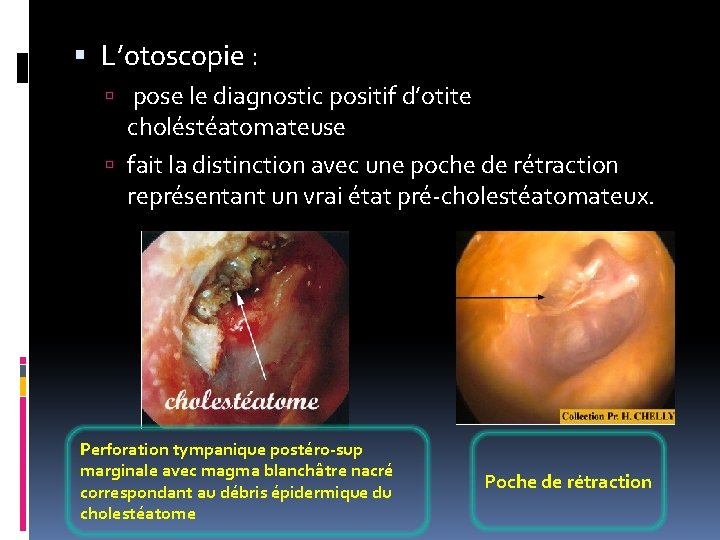  L’otoscopie : pose le diagnostic positif d’otite choléstéatomateuse fait la distinction avec une