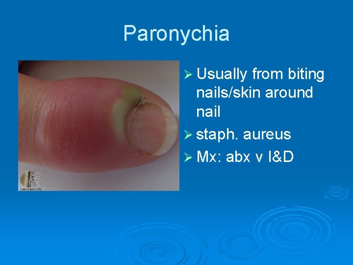 Paronychia Ø Usually from biting nails/skin around nail Ø staph. aureus Ø Mx: abx