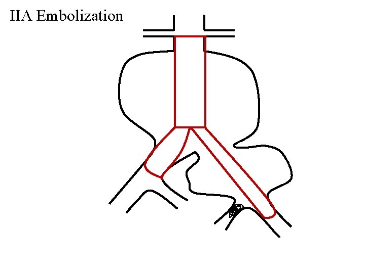 IIA Embolization 