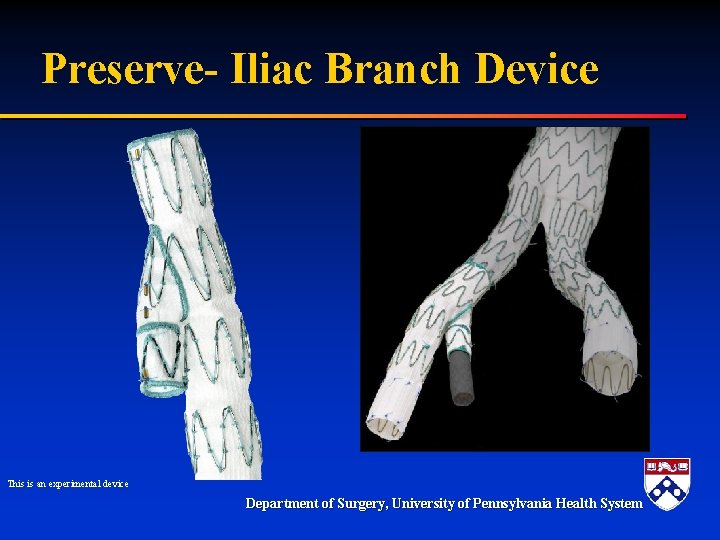 Preserve- Iliac Branch Device This is an experimental device Department of Surgery, University of