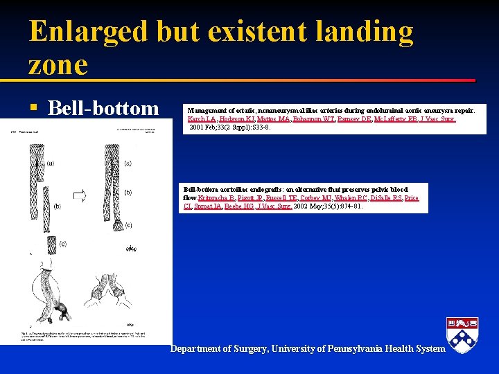 Enlarged but existent landing zone § Bell-bottom Management of ectatic, nonaneurysmal iliac arteries during