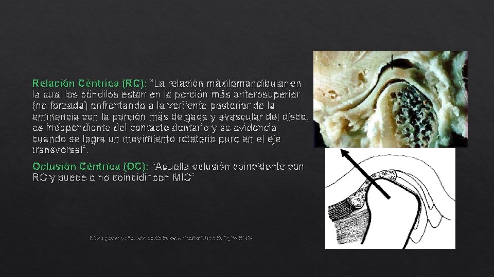 Relación Céntrica (RC): “La relación máxilomandibular en la cual los cóndilos están en la
