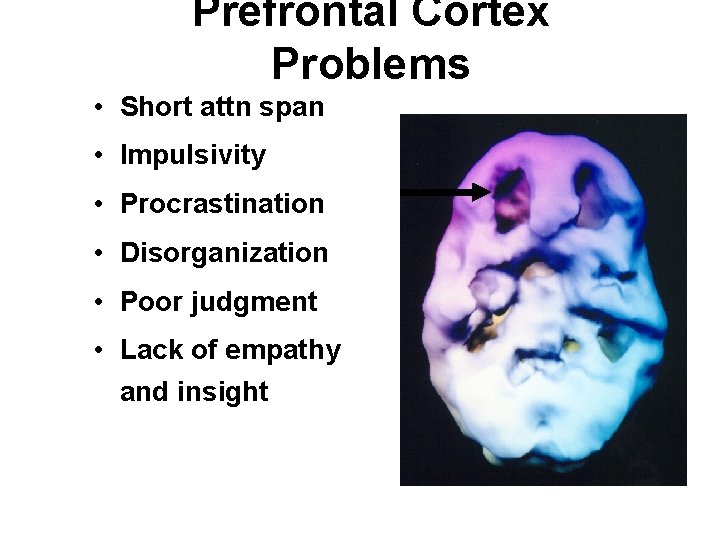 Prefrontal Cortex Problems • Short attn span • Impulsivity • Procrastination • Disorganization •