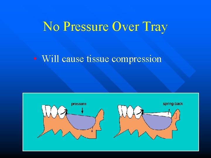 No Pressure Over Tray • Will cause tissue compression 