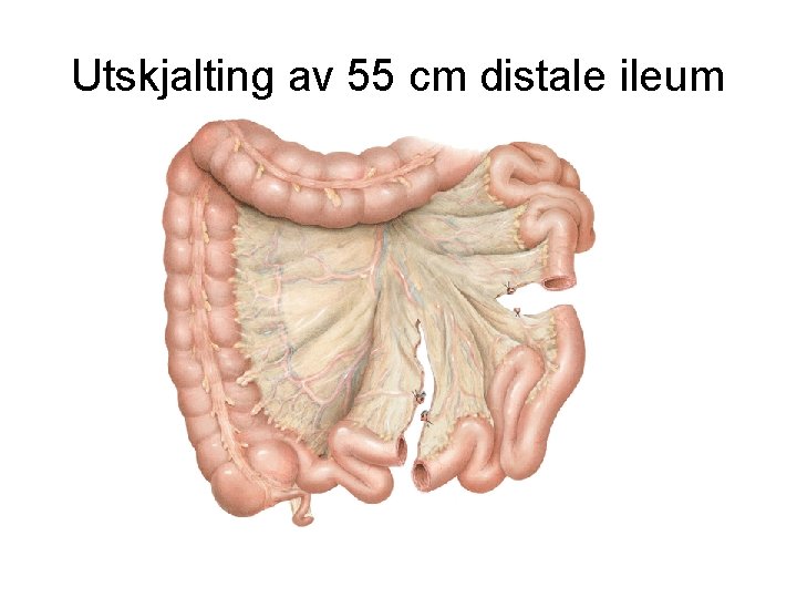 Utskjalting av 55 cm distale ileum 