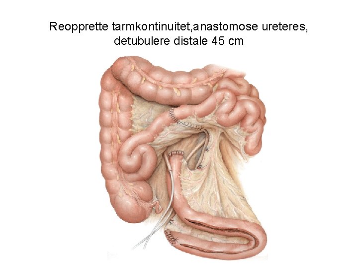 Reopprette tarmkontinuitet, anastomose ureteres, detubulere distale 45 cm 