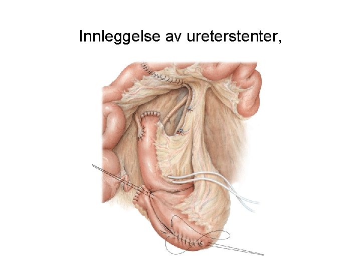 Innleggelse av ureterstenter, 